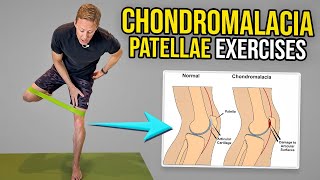 Chondromalacia Patella Exercises Knee Pain Rehab [upl. by Aivek]