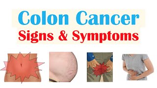 Colon Cancer CRC Signs amp Symptoms amp Why They Occur [upl. by Ahsam449]