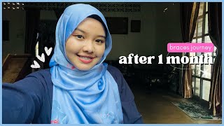 Braces Journey😁 1 MONTH BRACES UPDATE  Malaysia [upl. by Arac328]