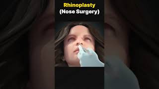 Rhinoplasty [upl. by Damas]