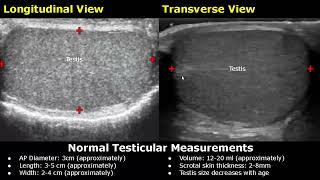 How To Measure Scrotum On Ultrasound  Testis Epididymis AP Diameter Length Width amp Volume USG [upl. by Sabah867]