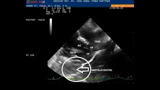 CONDUCTO ARTERIOSO PERSISTENTE PDA CLASICO ID SEDICARVET 7 [upl. by Cherie294]