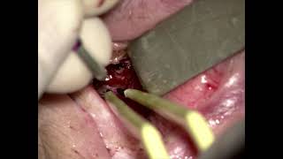 TONES Surgery – Cauterization Graphic [upl. by Socha]