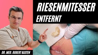 RIESENKOMEDO in der Leiste entfernt Hautarzt kann es kaum fassen Mitesser pimple giant comedone [upl. by Enaillil]