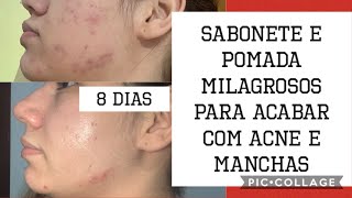 ACABANDO COM A ACNE  SABONETE TAYUCAROBA  POMADA BETAMETASONA  ÁCIDO SALICÍLICO [upl. by Mcclimans]