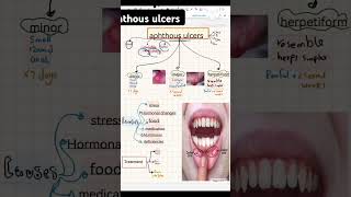 Aphthous ulcers dental dentistrydegree dentistdoctor dentistrystudent [upl. by Nairoc33]