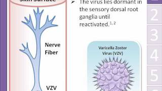 Shingles herpes zoster Animation  Michael Freudiger [upl. by Shari877]