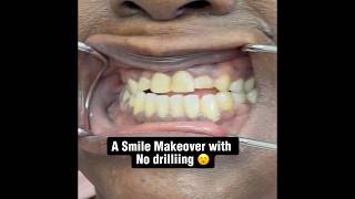 No drill Removable Veneers 😮 [upl. by Castara]