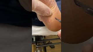 Expert Australian Podiatrist Removes Painful Corns with Precision [upl. by Dielle]