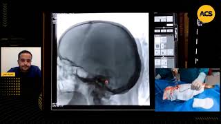 CAROTID STENTING STEP BY STEP Dr Åžakir ARSLAN [upl. by Eatton]