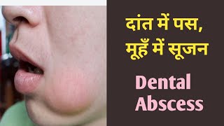 दांत में पस सूजन मवाद पस कारणइलाज Tooth Abscess Mouth Swelling pus reason and its treatment [upl. by Dosi]