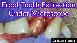 Front tooth got extracted UNDER A MICROSCOPE  Front Tooth Removal Procedure  Teeth Pulled Out [upl. by Clarkin292]