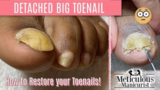 How To Pedicure Transformation for Men on Detached Toenails [upl. by Oremar912]