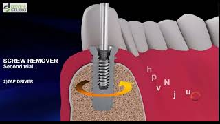 Dental Implant Prosthetic SCREW removal [upl. by Aicnom]