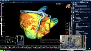 Live Case PVC Ablation  Marchlinski Electrophysiology Lab at Penn Medicine [upl. by Yrahk]