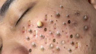 ACNE TREATMENT VU QUYNH MI Blackheads Removal Popping [upl. by Suzi436]