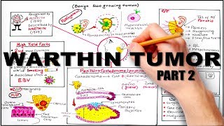 Warthin Tumor Salivay Gland Neoplasm  part 2 [upl. by Girardo706]