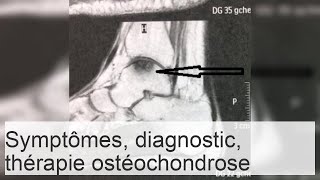 Lostéochondrose du bras  symptômes méthodes de détection de la pathologie traitement [upl. by Assennev224]