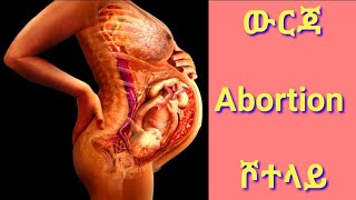 ውርጃ ና የደም አይነት ድንገተኛ ፅንስ መቋረጥ AbortionRh IncompatibilityDr Habesha Infoketena guadatenawo [upl. by Mraz]