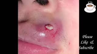 Pimple Pop React Huge Upper Lip Pop [upl. by Sander]