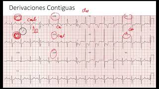 Derivaciones Contiguas EKG [upl. by Anitirhc65]