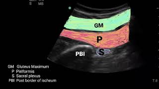 How To UltrasoundGuided Popliteal Sciatic Nerve Block Scanning Technique Video [upl. by Anivle]