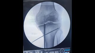 MEDIAL MENISCUS ROOT TRANSTIBIAL PULL OUT REPAIR [upl. by Swope650]