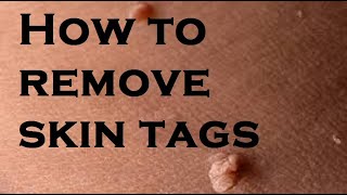 How to remove skin tags [upl. by Perlie557]