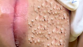 Big Cystic Acne Blackheads Extraction Blackheads amp Milia Whiteheads Removal Pimple Popping  6553 [upl. by Ibloc]