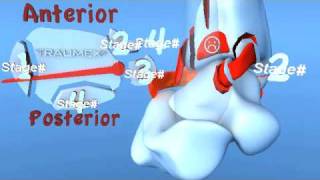 Lauge Hansen PER Pronation External Rotation Eversion Ankle Fracture [upl. by Rabma981]