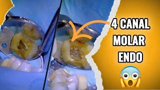 87 Live Root Canal and Crown for Severe Toothache [upl. by Acilegna]