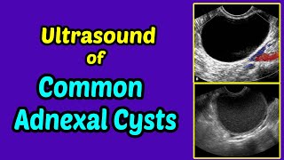 Ultrasound of Common Adnexal Cysts [upl. by Leuqer]