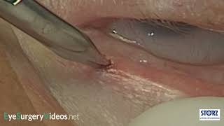 Punctoplasty Punctal 3snip Procedure [upl. by Bruce]