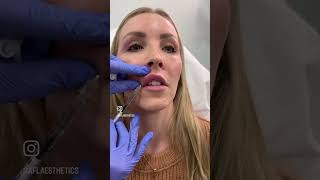 Dissolving Lip Filler  Beautiful After Results [upl. by Zuleika]