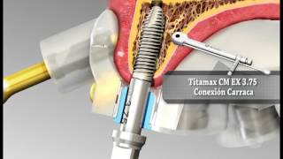 Guía quirúrgica en implantes dentales  Implantes NEODENT [upl. by Mcnair]