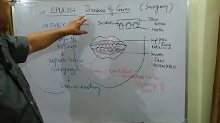 Surgery topic EPULIS part 1 [upl. by Assecnirp]