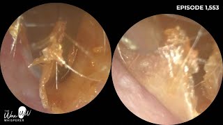 1553  Complete Dead Skin Peel of the Ear [upl. by Wallraff3]