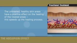 Fractional therapy with Erbium laser by Asclepion [upl. by Ketchum]