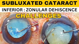 Subluxated Cataract Phacoemulsification  CTR insertion  Dr Deepak Megur [upl. by Guilbert]