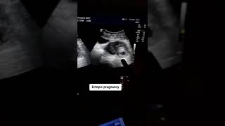 Ectopic pregnancy Positive 7 weeks [upl. by Savdeep]