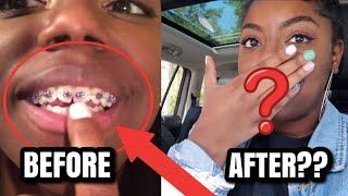 GETTING MY BRACES OFF COME WITH ME  VLOG [upl. by Norvell]