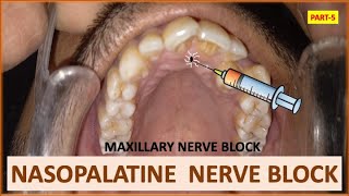 NASOPALATINE NERVE BLOCK PART5 MAXILLARY NERVE BLOCK ORAL SURGERY dentalcafe4331 [upl. by Terraj]