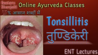 Tonsillitis or तुण्डिकेरी [upl. by Sral18]