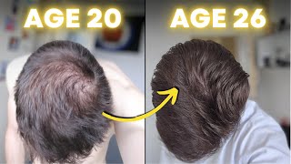 My INSANE 18Month Hair Regrowth Dermaroller Minoxidil amp Finasteride [upl. by Emelin]