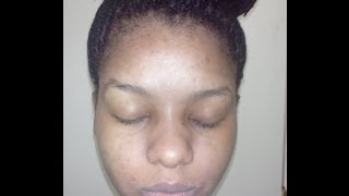 How kojic acid soap changed my face week 4 before and after pictures [upl. by Chloette]