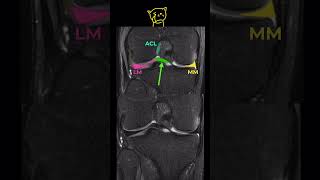 3Fig 1A17 Oblique meniscomeniscal ligament [upl. by Orth]