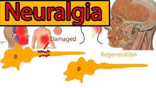 Neuralgia Explained under 3 minutes Trigeminal Neuralgia symptoms and treatment [upl. by Iggam763]