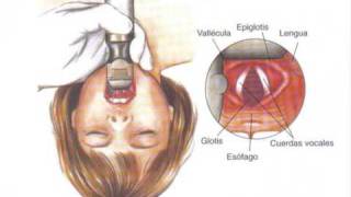 Colocación de Sonda Orotraqueal [upl. by Lambart223]