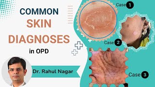 Common Skin Diagnoses In OPD [upl. by Eiuol698]