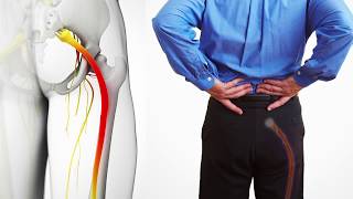 What is Sciatica Causes and Treatment [upl. by Lletram939]